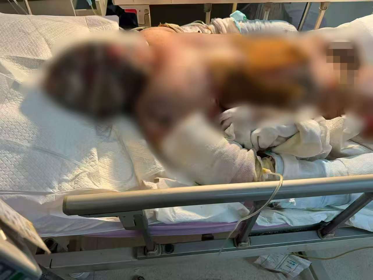 父子在哈尔滨一亲戚公司上班遇爆炸全身烧伤<strong></p>
<p>比特币实时</strong>，治疗花费近百万公司拒赔偿？亲戚回应