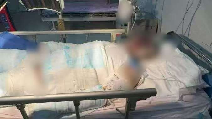 父子在哈尔滨一亲戚公司上班遇爆炸全身烧伤<strong></p>
<p>比特币实时</strong>，治疗花费近百万公司拒赔偿？亲戚回应