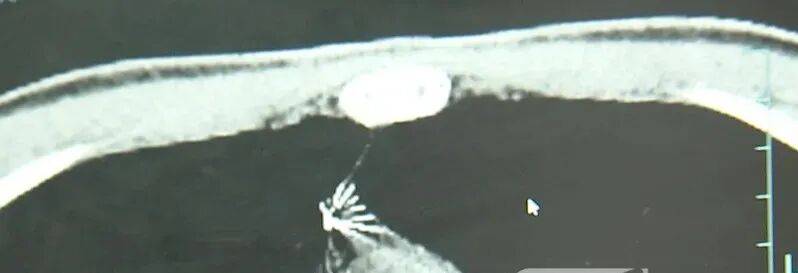 17岁小伙参军体检发现胸腔内有根5cm缝衣针<strong></p>
<p>比特币下载</strong>,父母回忆或是1岁时扎入,取出时已锈迹斑斑