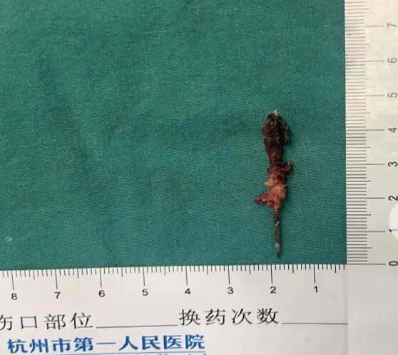 17岁小伙参军体检发现胸腔内有根5cm缝衣针<strong></p>
<p>比特币下载</strong>,父母回忆或是1岁时扎入,取出时已锈迹斑斑